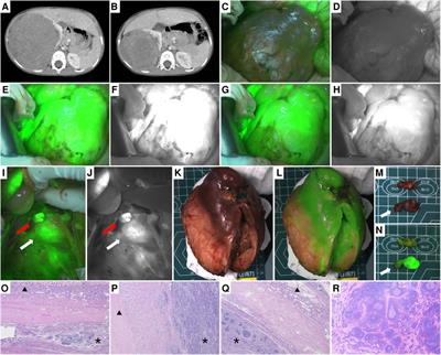 Clinical application of indocyanine green fluorescence imaging navigation for pediatric renal cancer